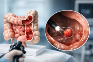 Quando retirar pólipo do intestino com segurança