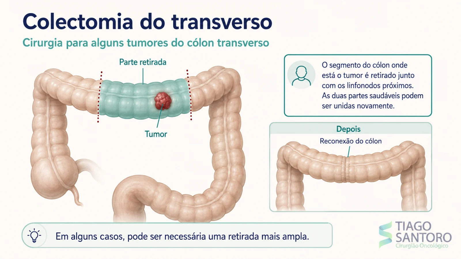 Colectomia do transverso: ilustração do segmento do cólon retirado e da reconexão