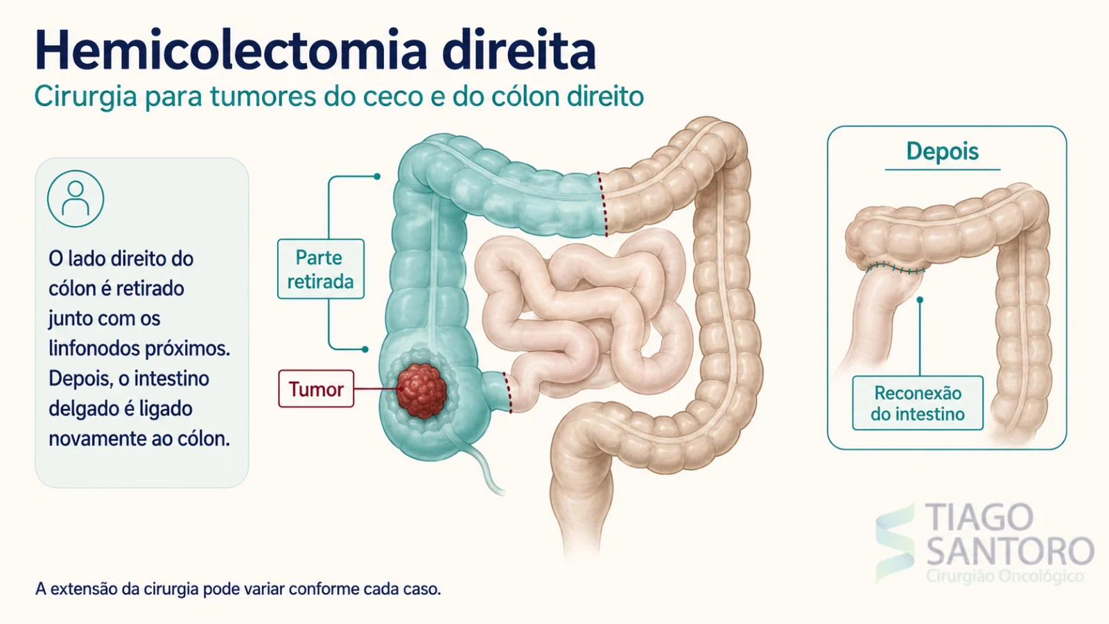 Hemicolectomia direita: ilustração da parte do cólon retirada e da reconexão do intestino delgado ao cólon