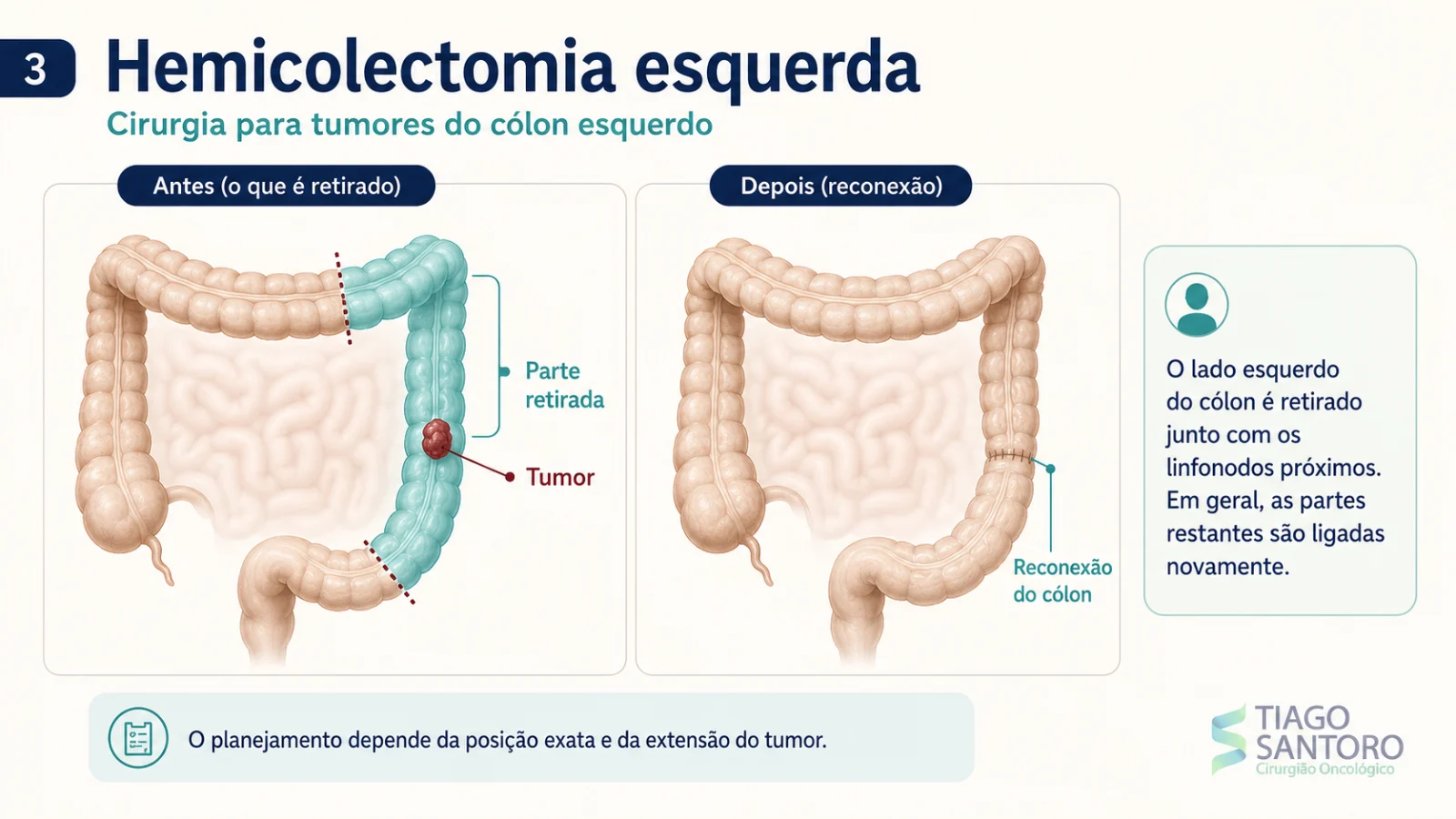 Hemicolectomia esquerda: ilustração da parte retirada do cólon esquerdo e da reconexão do cólon