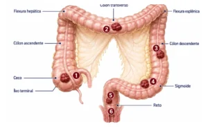 Ilustração do intestino grosso com tumores marcados do ceco ao reto