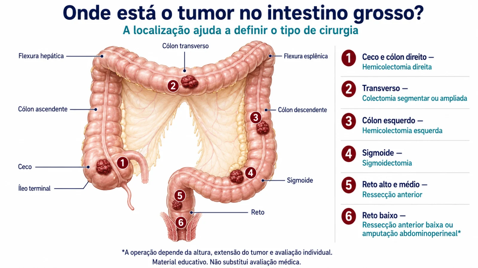 Onde está o tumor no intestino grosso: infográfico com seis localizações numeradas e a cirurgia indicada para cada uma