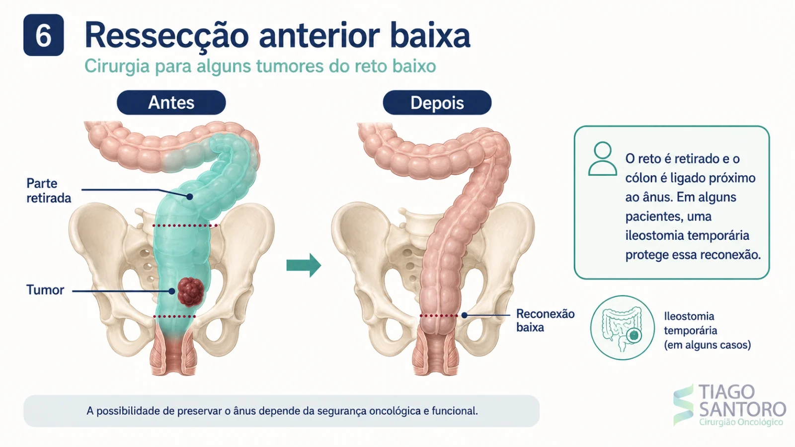 Ressecção anterior baixa: ilustração do reto retirado e da reconexão do cólon próxima ao ânus