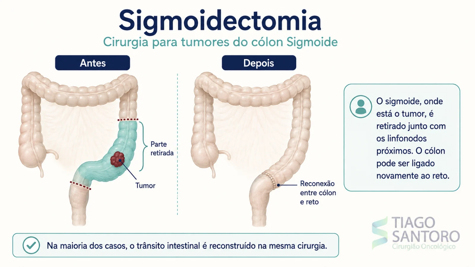 Sigmoidectomia: ilustração do sigmoide retirado e da reconexão entre cólon e reto