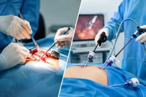 Cirurgia aberta ou laparoscópica: qual indicar?